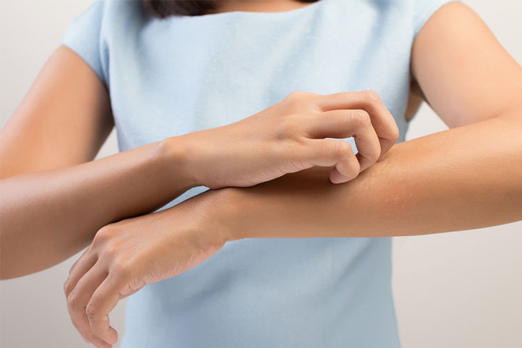 アトピー性皮膚炎のイメージ写真